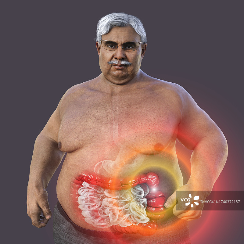 肠易激综合征插图图片素材