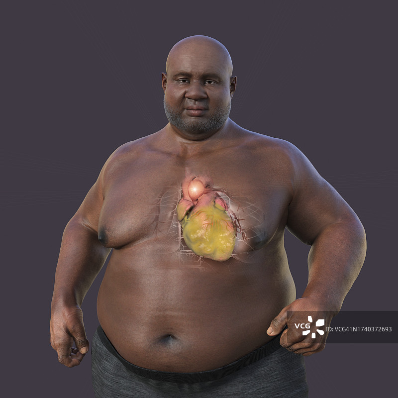 患有升主动脉瘤的肥胖男人，插图图片素材