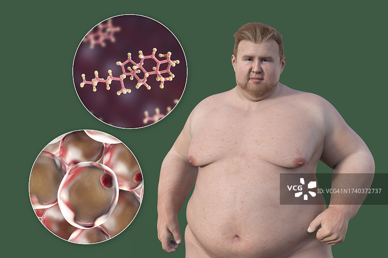 肥胖男人、脂肪细胞和胆固醇插画图片素材