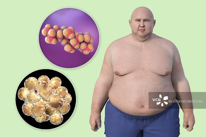 肥胖男人、脂肪细胞和胆固醇插画图片素材