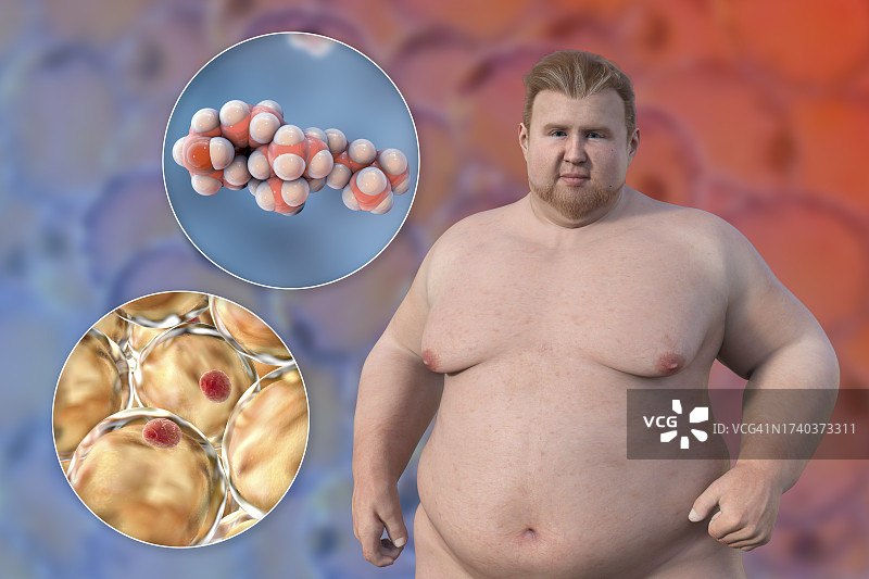 肥胖男人、脂肪细胞和胆固醇插画图片素材
