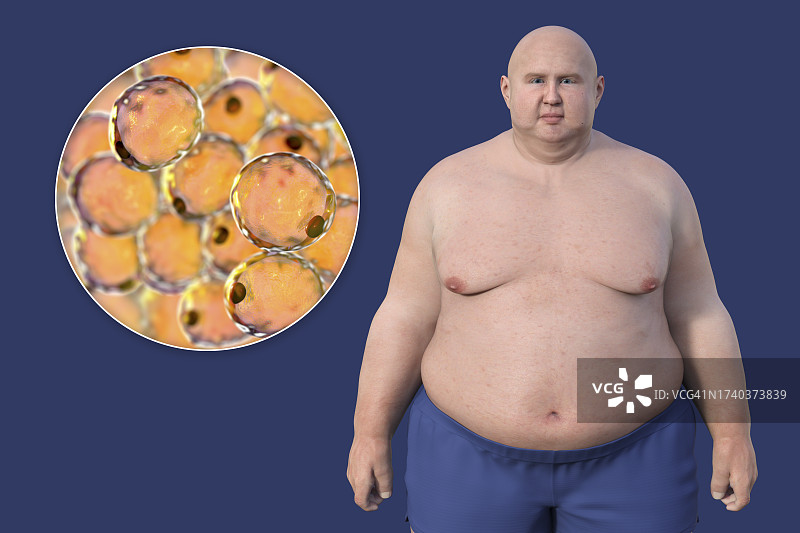 超重男子的脂肪细胞，插图图片素材
