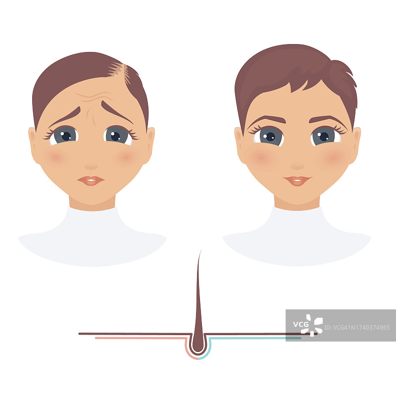 脱发恢复，概念插图图片素材