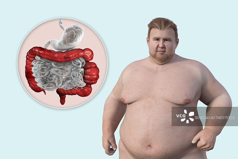 肠易激综合征插图图片素材