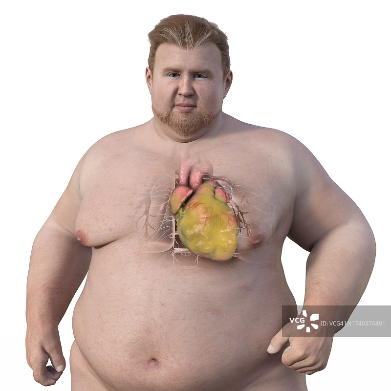 超重男人的心脏肥大插图图片素材