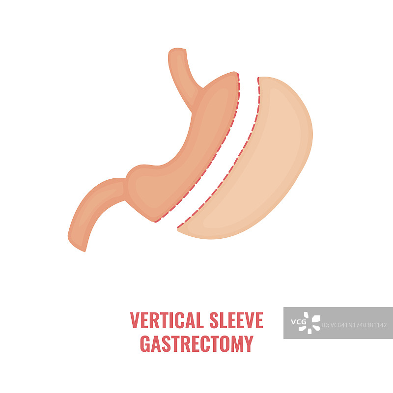 袖状胃切除术插图图片素材