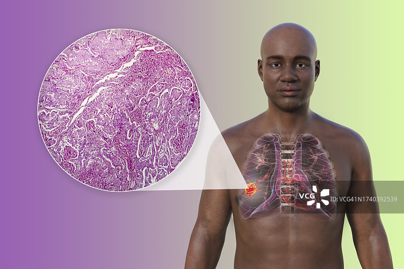 肺癌插图图片素材