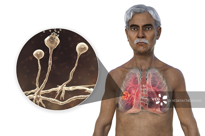 肺部毛霉菌病病变，图示图片素材