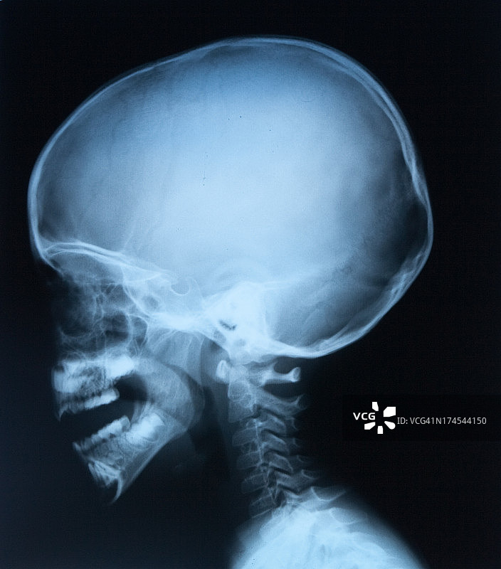 头部X光侧面图图片素材