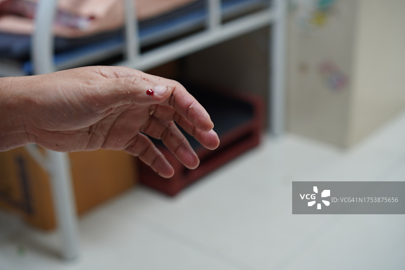 拇指上的出血伤口图片素材