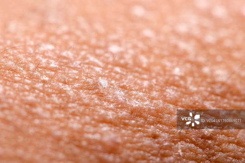 皮肤疾病特写图片素材