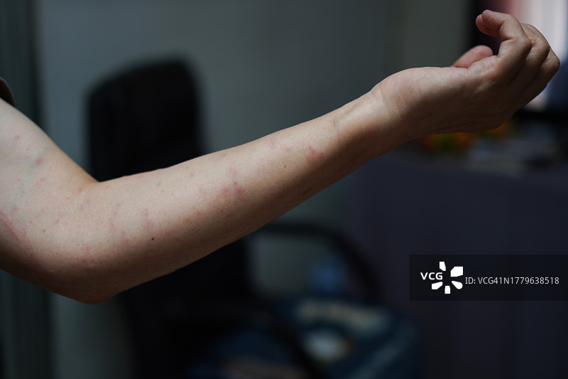 手臂上红色肿胀的皮疹图片素材