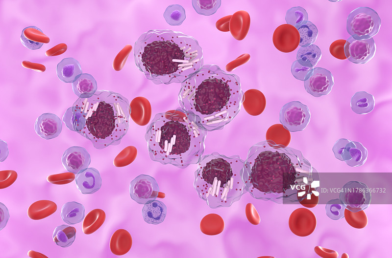 急性早幼粒细胞白血病中的奥尔小体插图图片素材