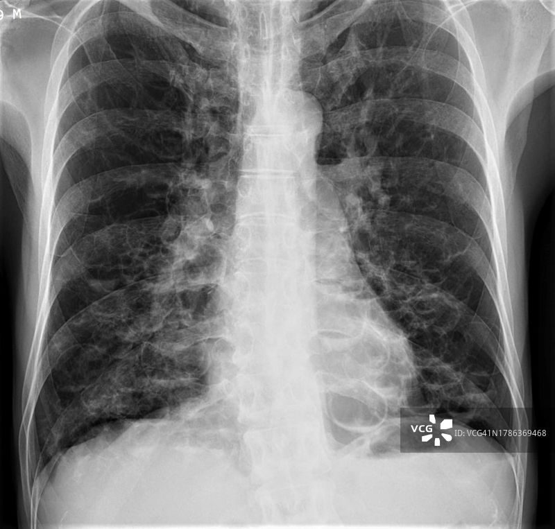 支气管扩张X光片图片素材