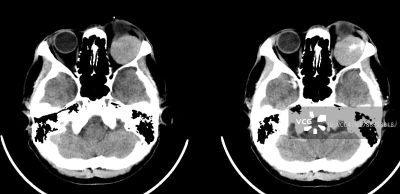 眼眶肿瘤CT扫描图片素材