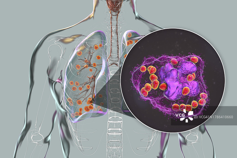 肺组织胞浆菌病插图图片素材