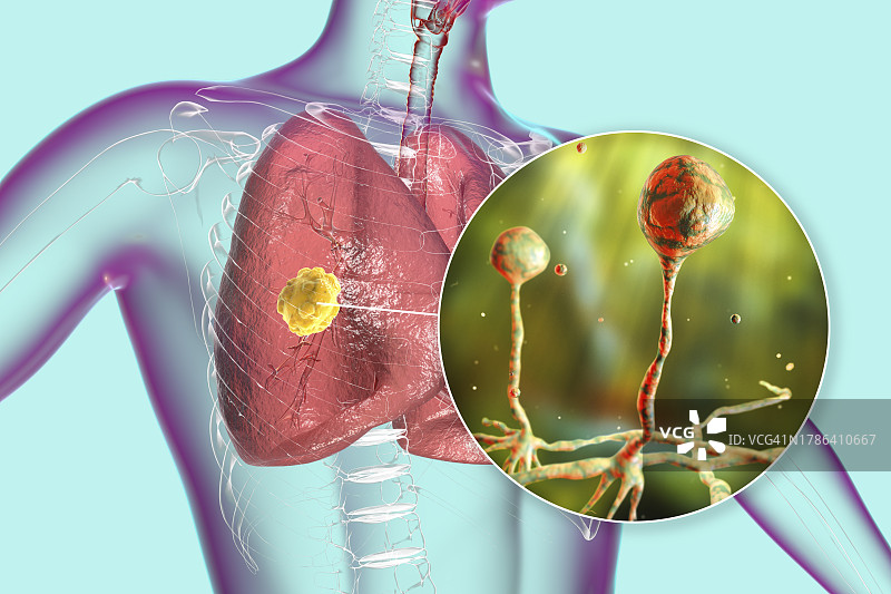 肺部毛霉菌病病变，图示图片素材