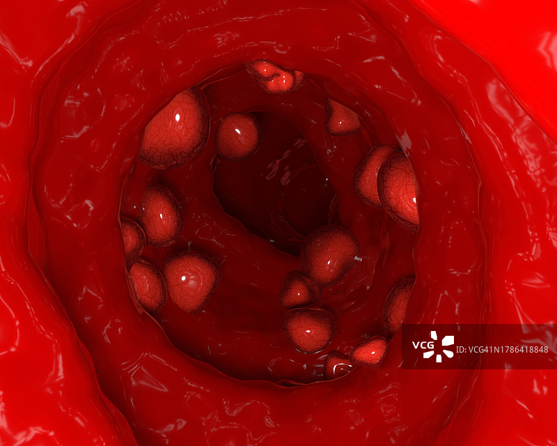 结肠癌，图示图片素材