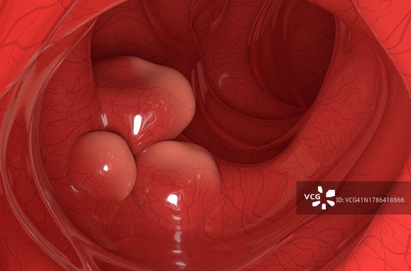 结肠癌，图示图片素材