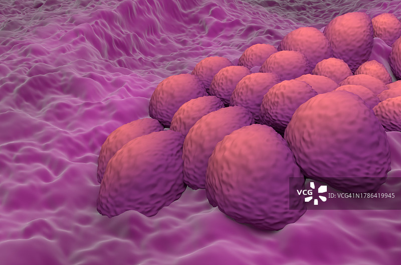 子宫内膜癌插图图片素材