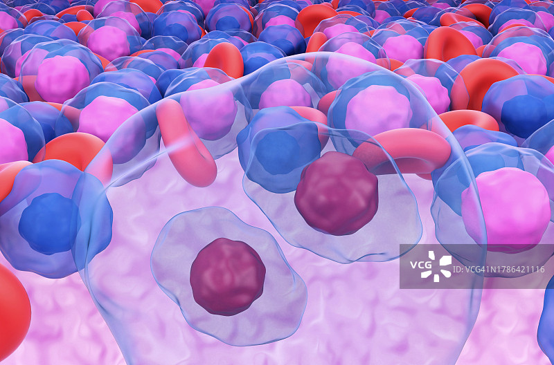 霍奇金淋巴瘤插图图片素材