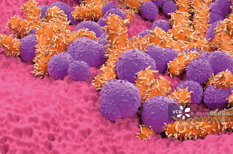 真菌性皮肤感染插图图片素材