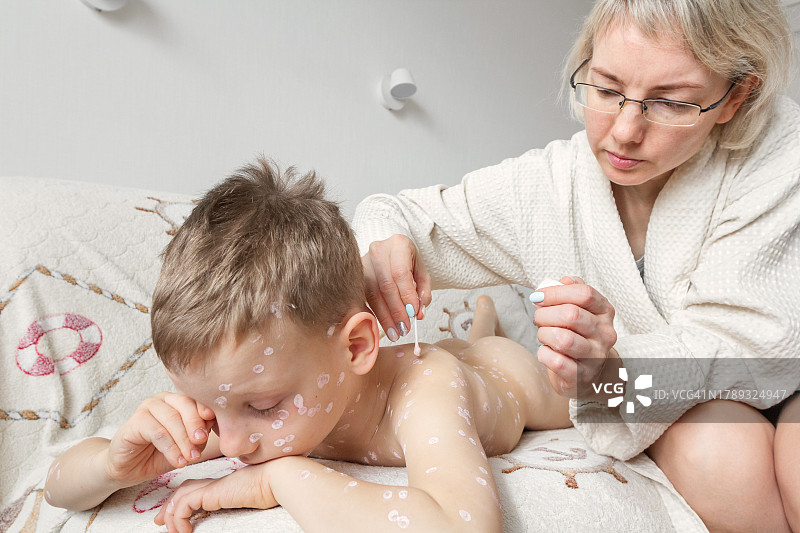 母亲为患水痘的儿子涂抹药膏图片素材