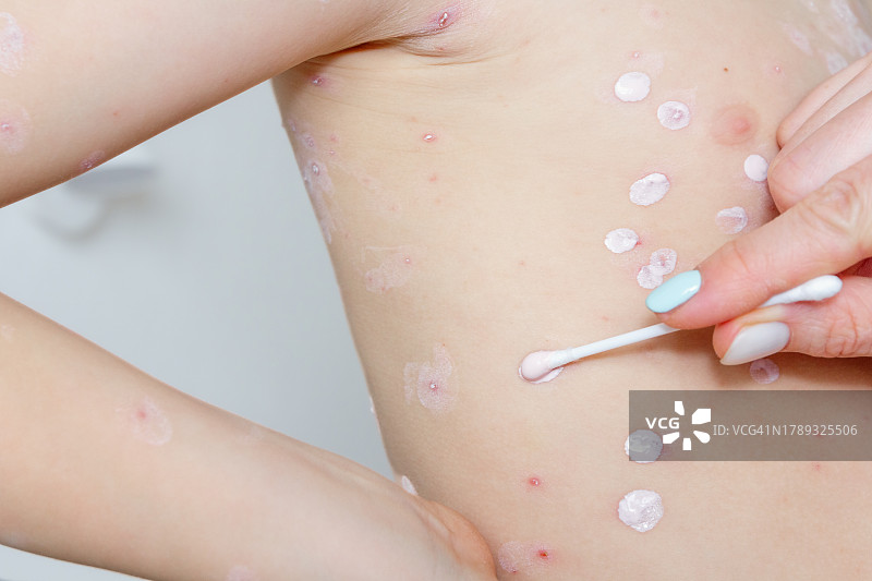 儿童水痘治疗：涂抹保湿霜图片素材