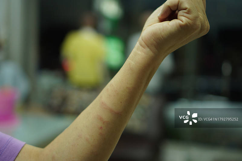 手臂上红色肿胀的皮疹图片素材