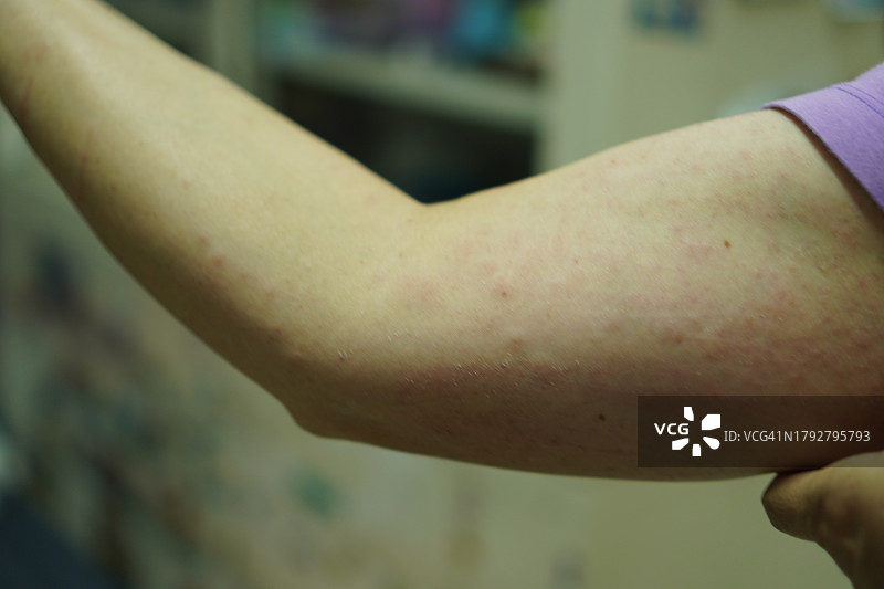 手臂上红色肿胀的皮疹图片素材