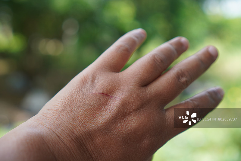 手背上的伤口图片素材