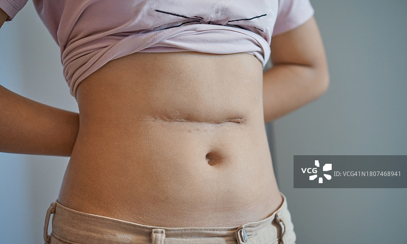 手术后腹部的大面积疤痕图片素材