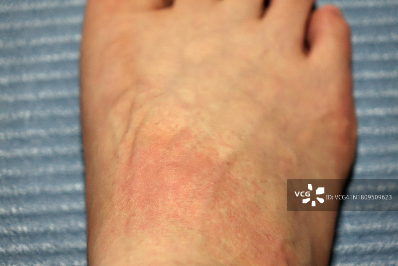 被蚊子叮咬的脚图片素材