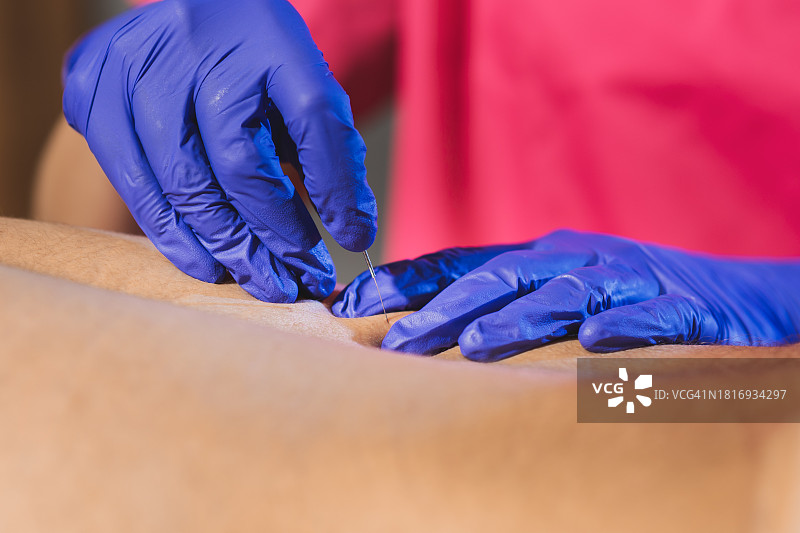 专业理疗师进行针灸图片素材