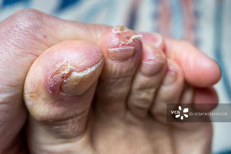 莱姆病引起的关节炎脚趾特写图片素材