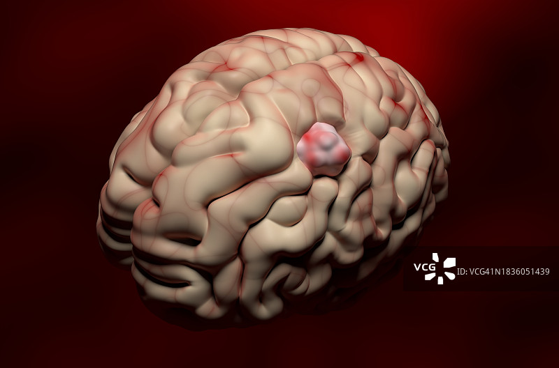 脑膜瘤，图示图片素材