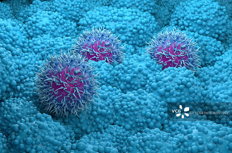 胰腺癌示意图图片素材