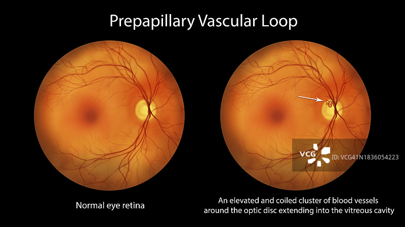 视网膜血管袢图示图片素材