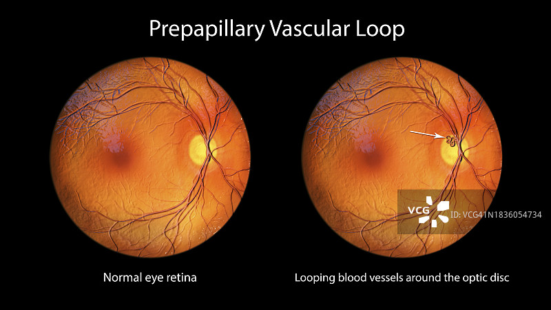 视网膜血管袢图示图片素材
