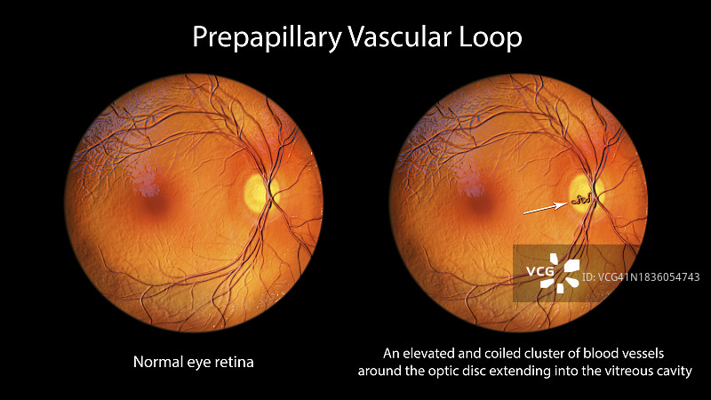 视网膜血管袢图示图片素材