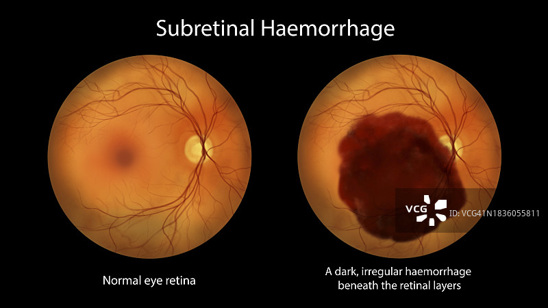 视网膜下出血插图图片素材