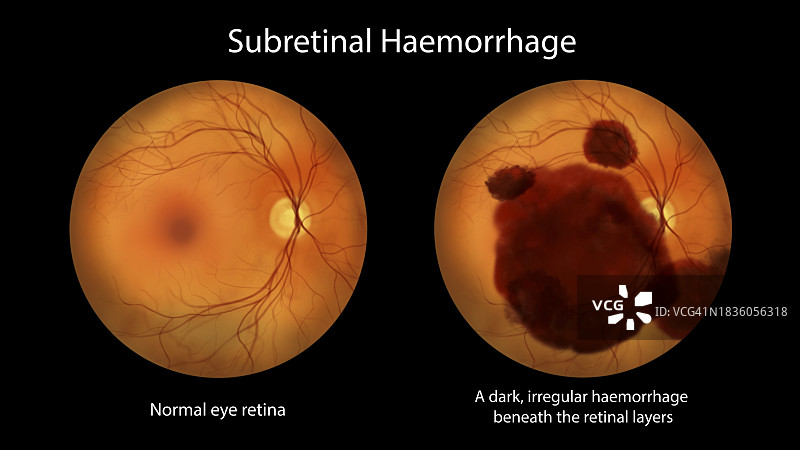 视网膜下出血插图图片素材