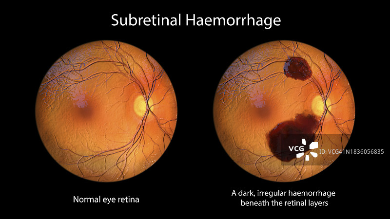 视网膜下出血插图图片素材