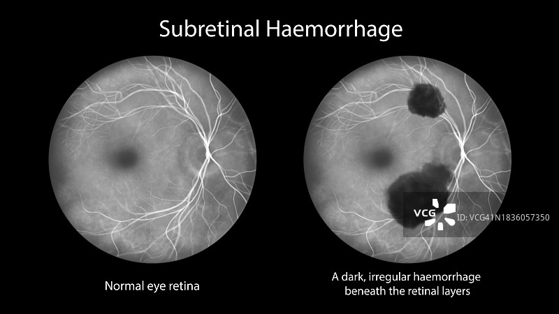 视网膜下出血插图图片素材
