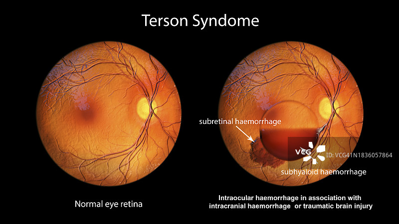 特尔松综合征眼内出血插画图片素材