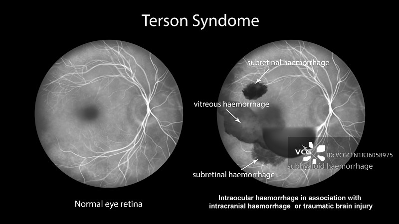 特尔松综合征眼内出血插画图片素材