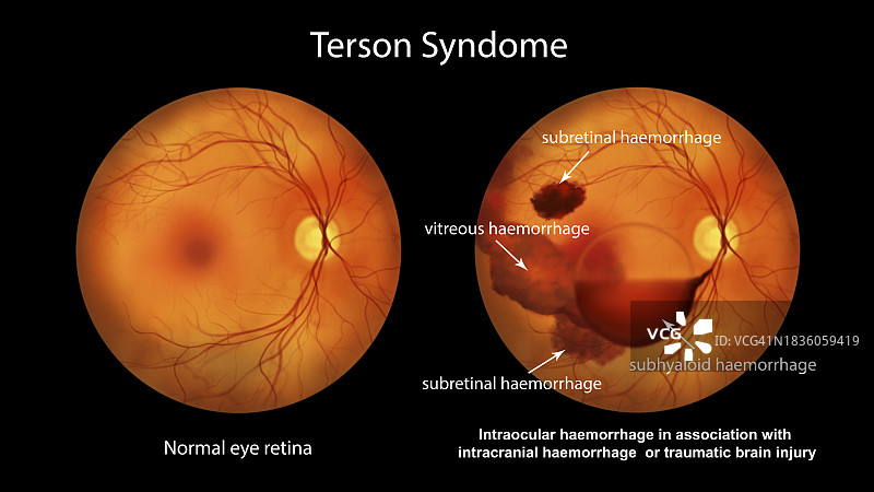 特尔松综合征眼内出血插画图片素材