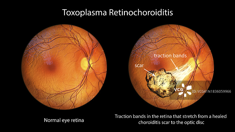 弓形虫性视网膜脉络膜炎插图图片素材