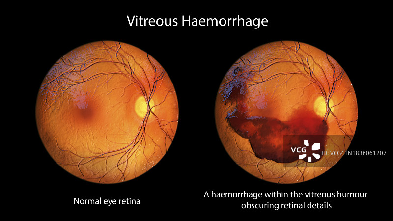 玻璃体出血插图图片素材
