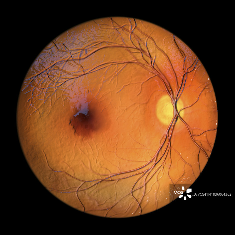 黄斑下出血插图图片素材
